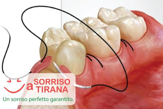 La Migliore Clinica per il Turismo Dentale, risparmia e sorridi con noi, Chi è La Migliore Clinica Dentale In Tirana, impianto dentale come funziona